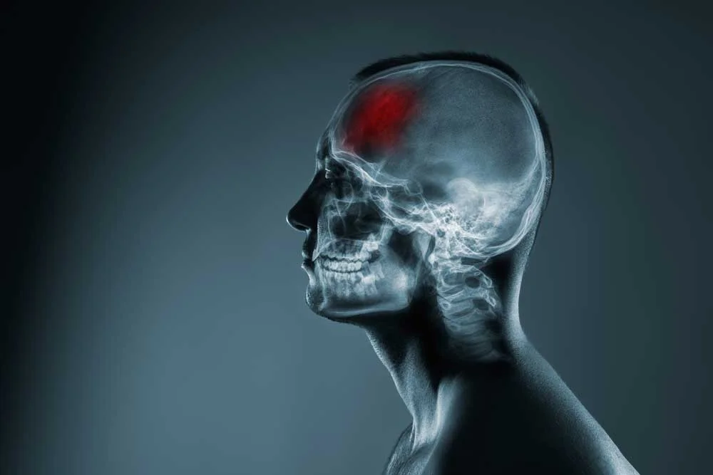 What Are Some Signs of a Serious Brain Injury?